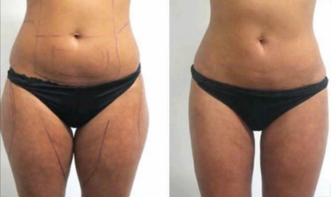 Before and After Lemon bottle