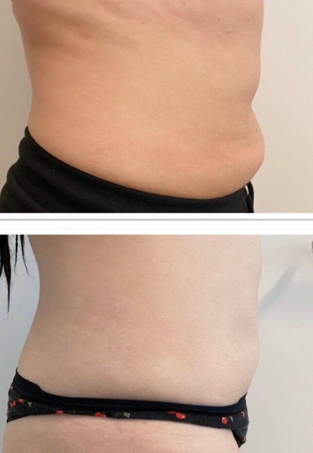 Before and After Lemon bottle